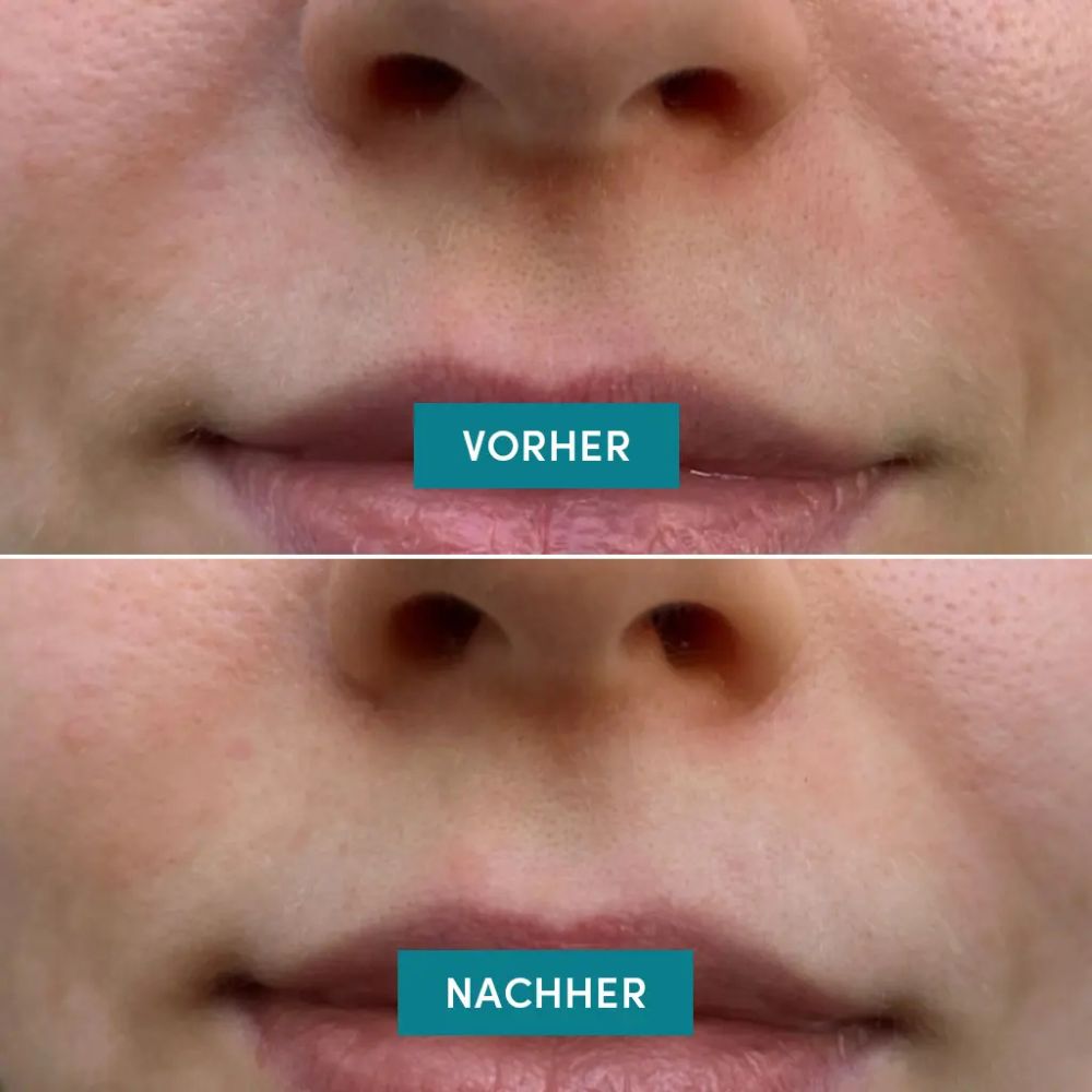 APRICOT I Mundfalten Pads "kiss it better" mit Ectoin - 100 Behandlungen