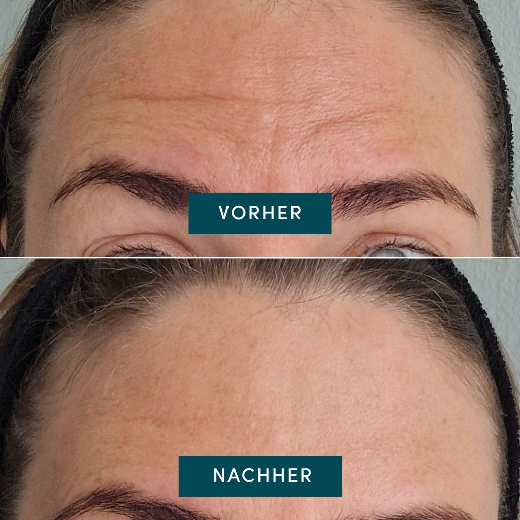 APRICOT I Zornfaltenpads mit Panthenol - 100 Behandlungen